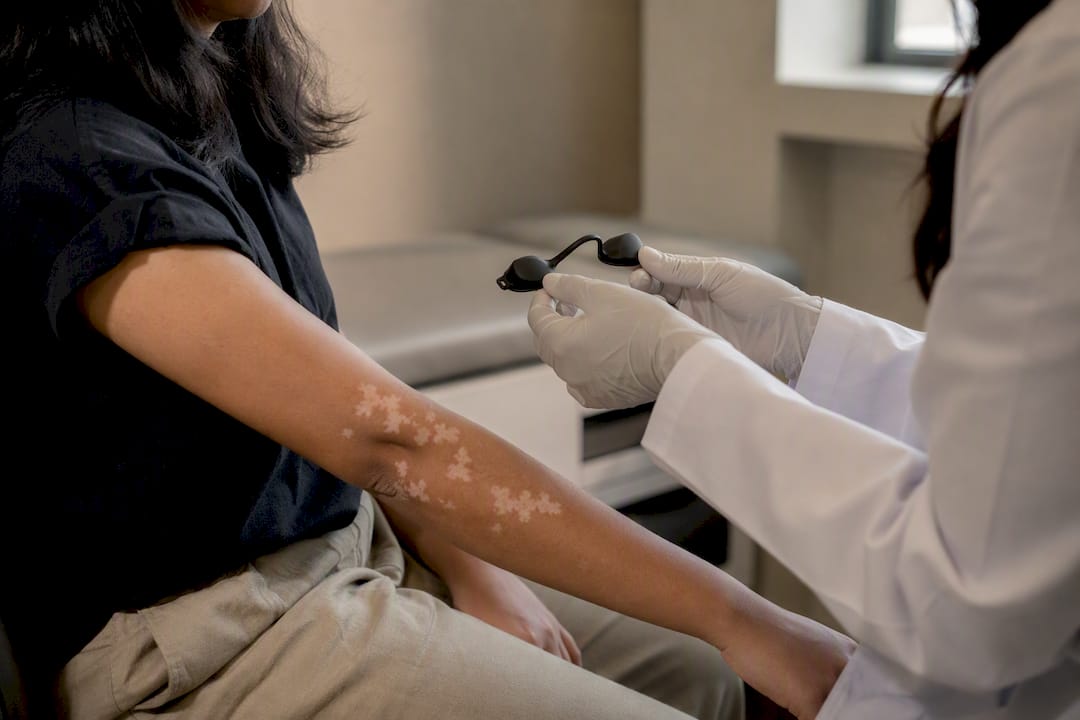 Dermatologist holding UV protection near vitiligo patch