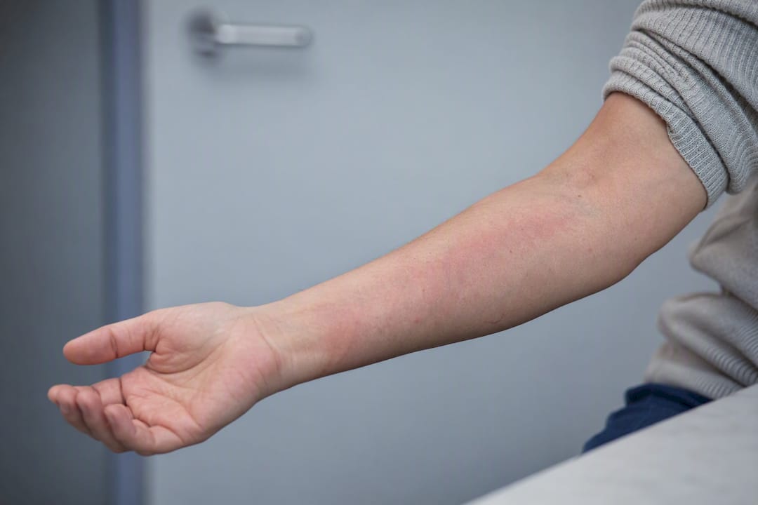 Forearm showing subtle nerve irritation signs