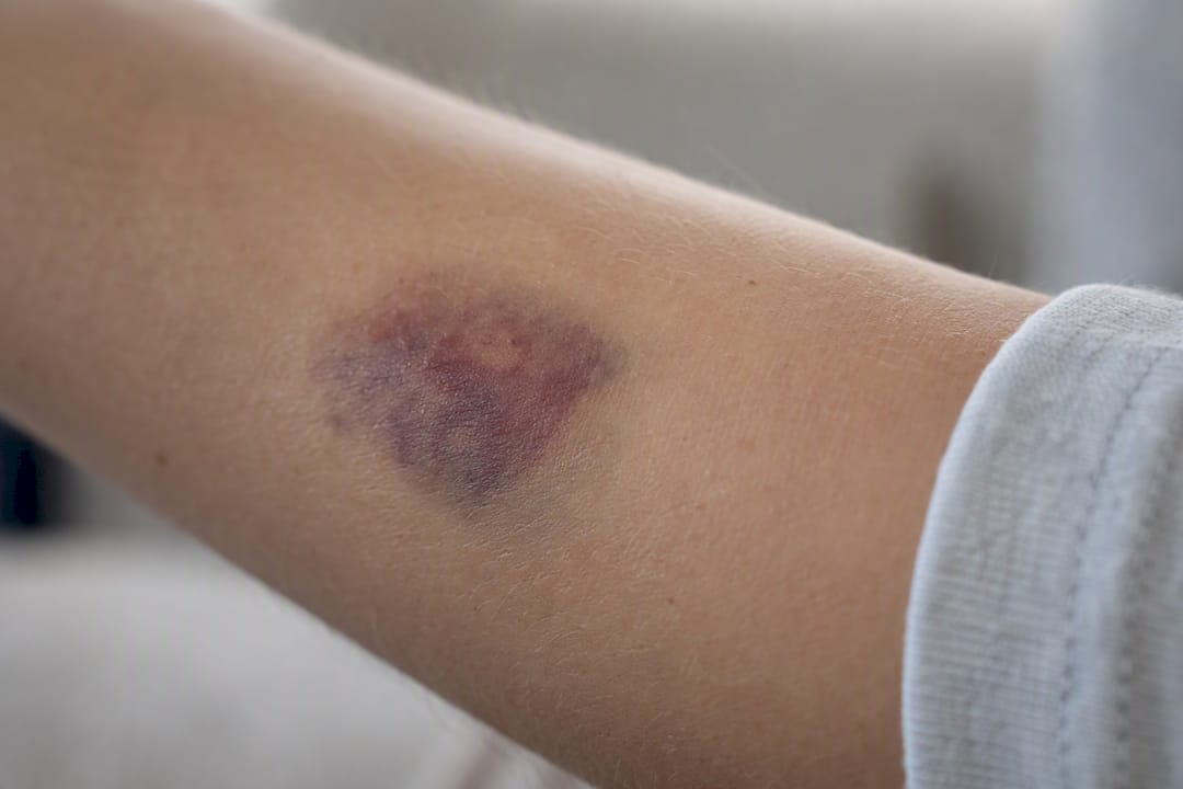 Bruise at blood draw site on arm