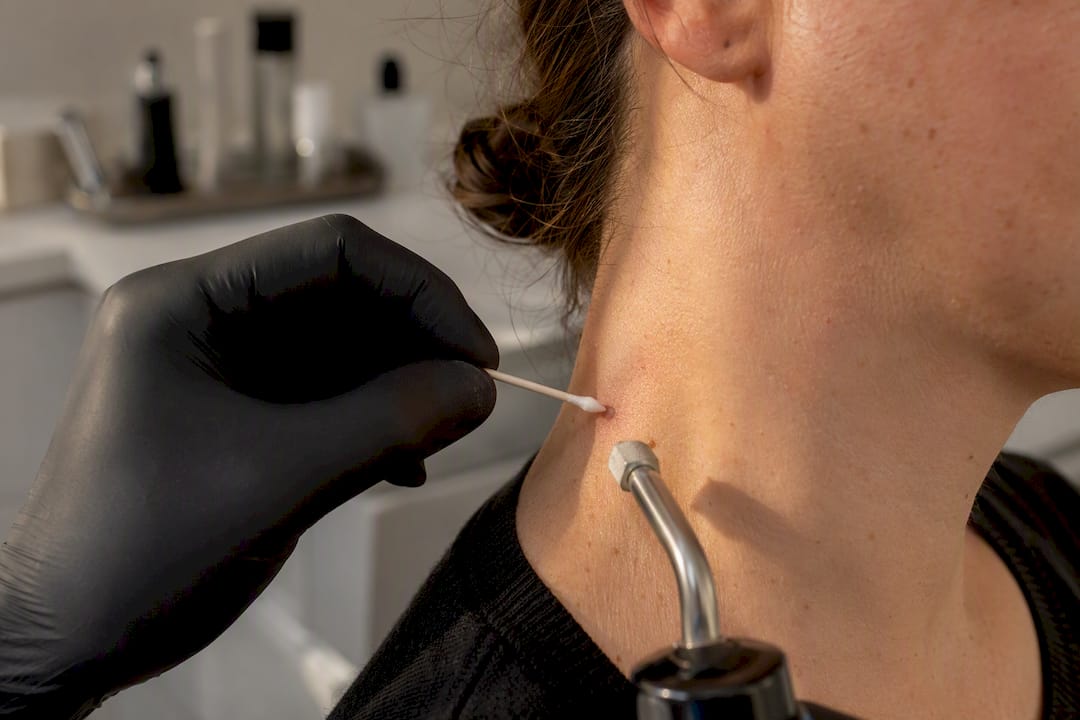Applying cryotherapy to skin tag with liquid nitrogen