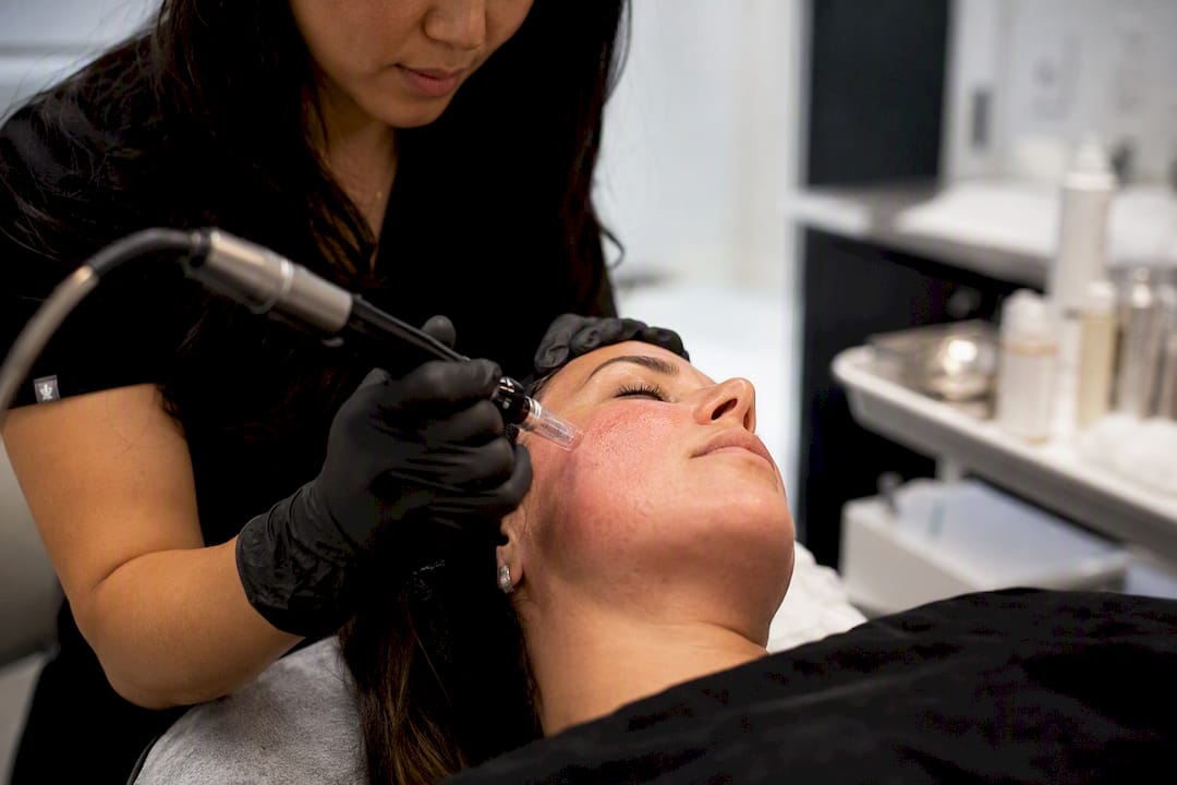 Microneedling device on skin in clinic