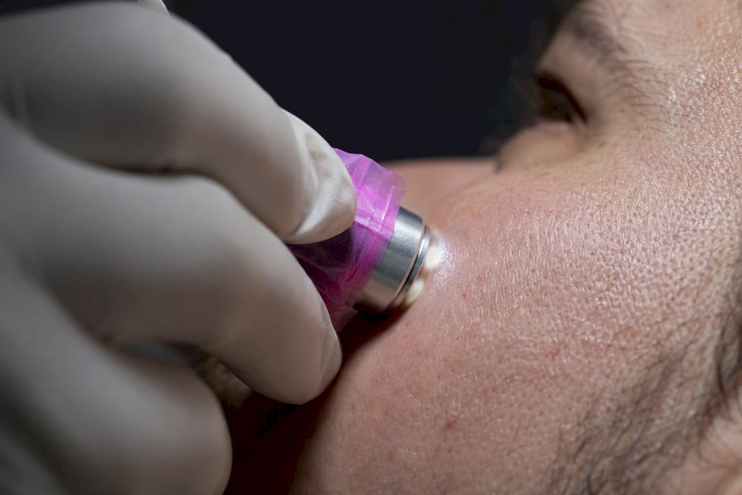 Confocal microscopy probe imaging facial skin