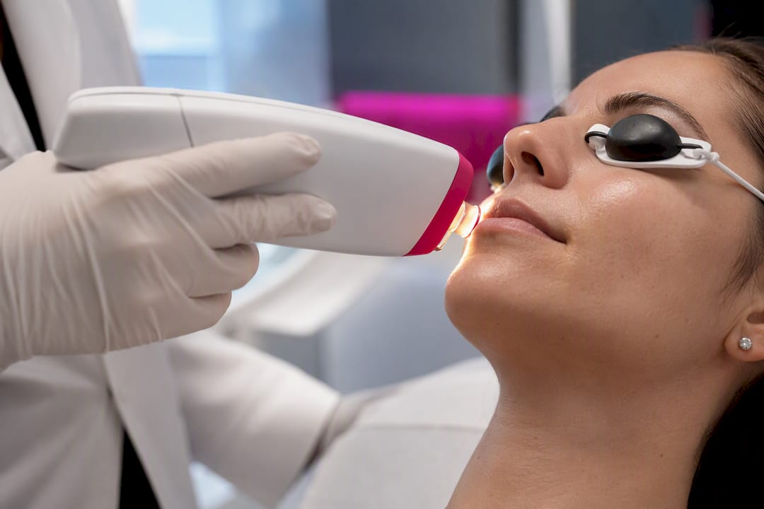 IPL handpiece positioned near patient cheek