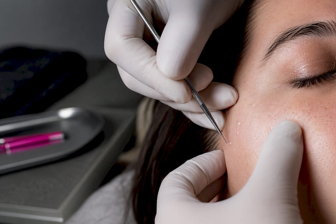 Dermatologist performing precise milia extraction