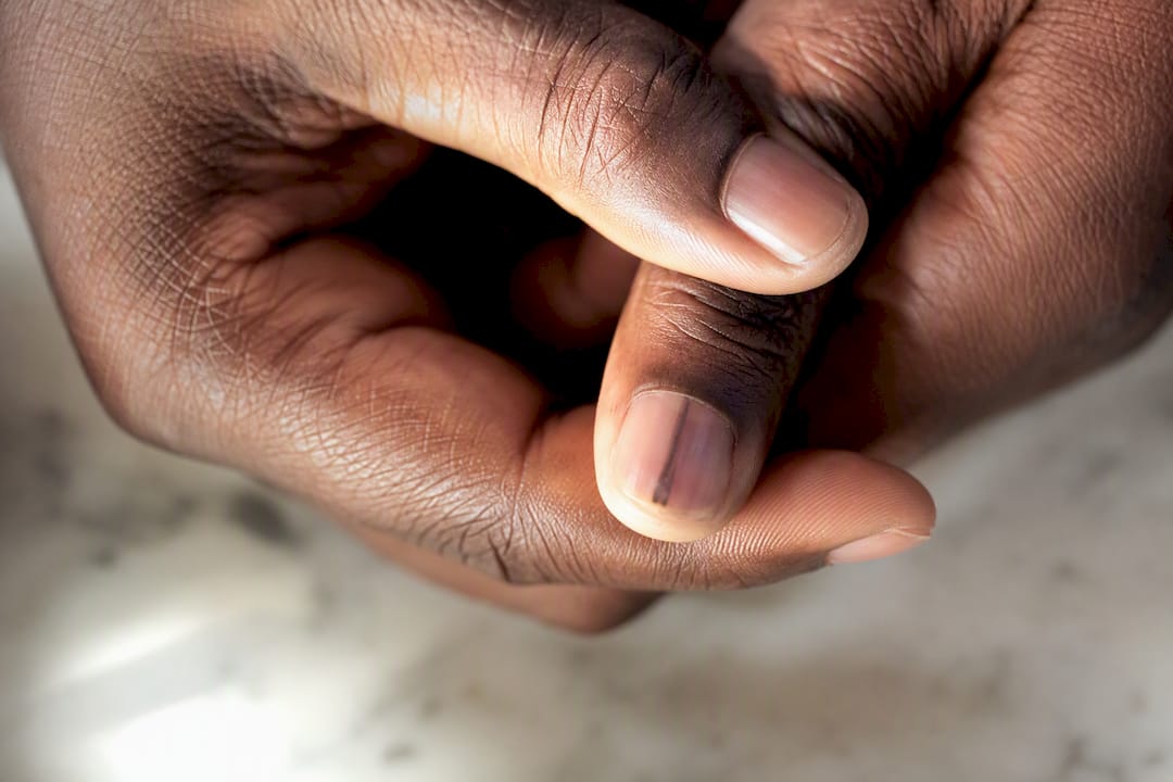 Dark irregular streak beneath a fingernail