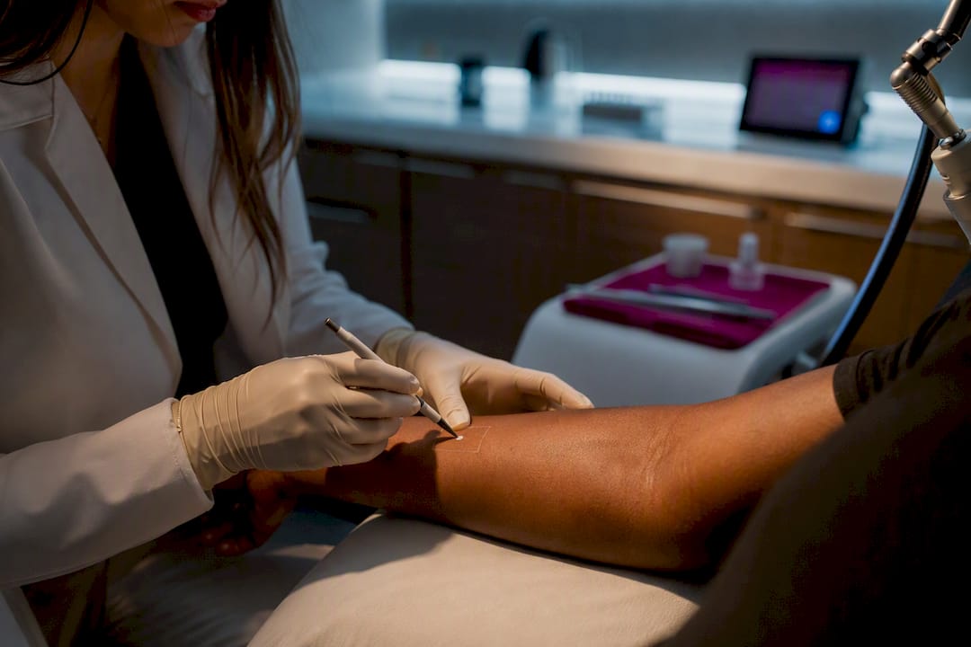 Clinician marking laser test spot on dark skin