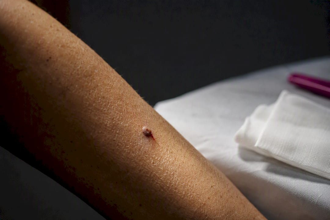 Small bleeding mole on forearm