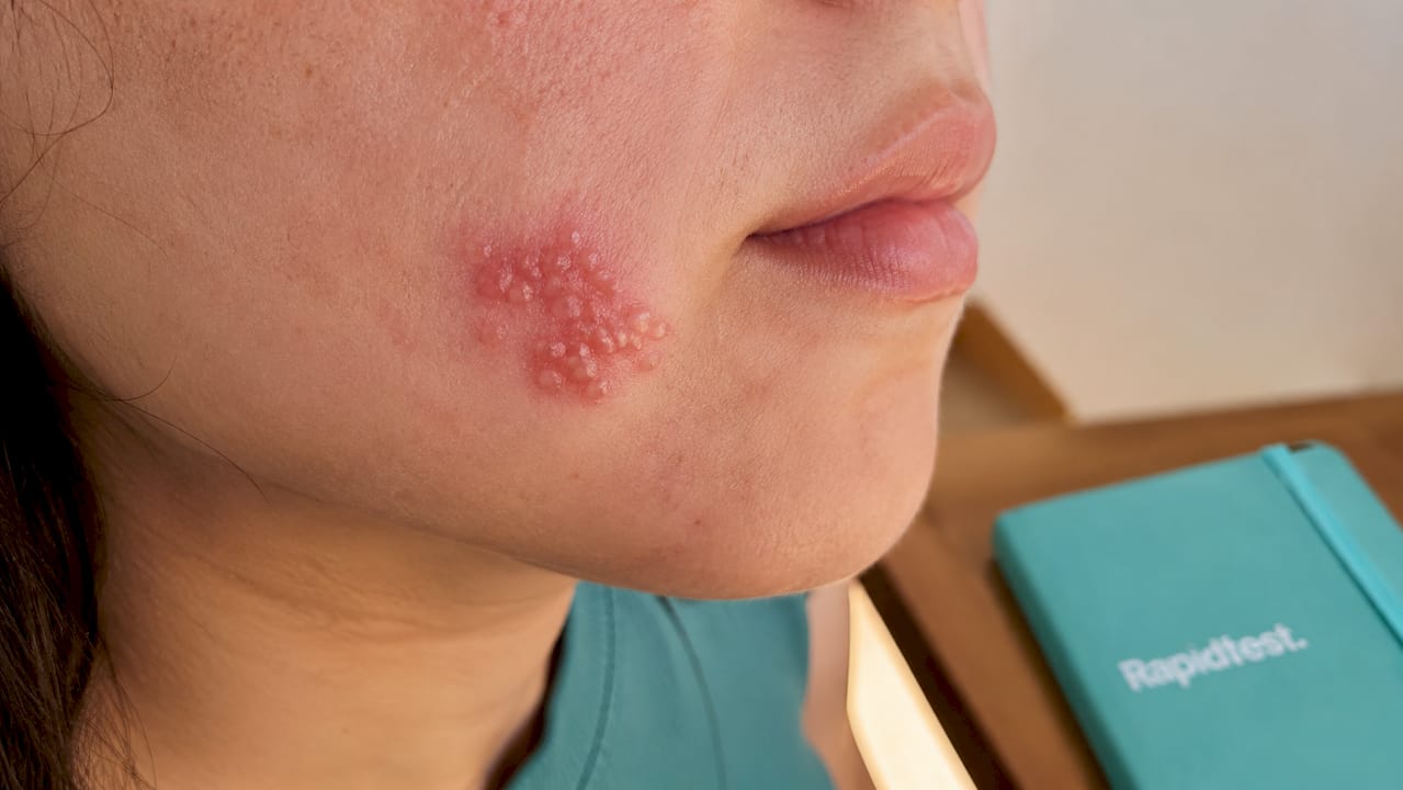 Close-up of clustered herpes lesions on skin