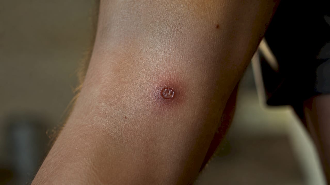 Close-up of syphilis chancre on skin