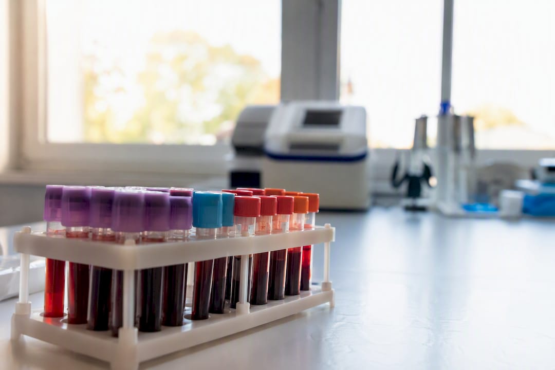 Cómo interpretar un análisis de sangre paso a paso