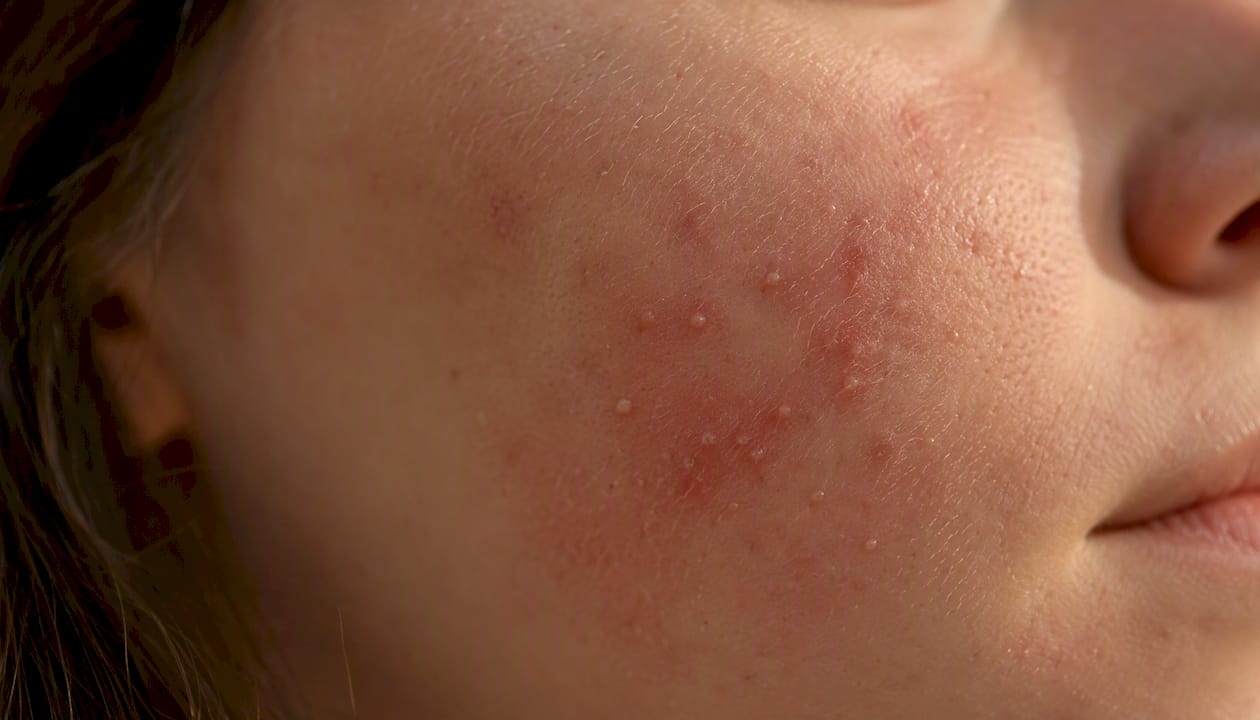 Close-up of skin showing whiteheads and redness