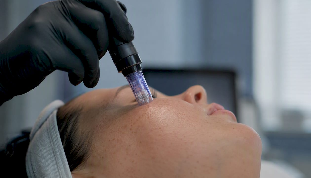 Microneedling device applied to skin close-up