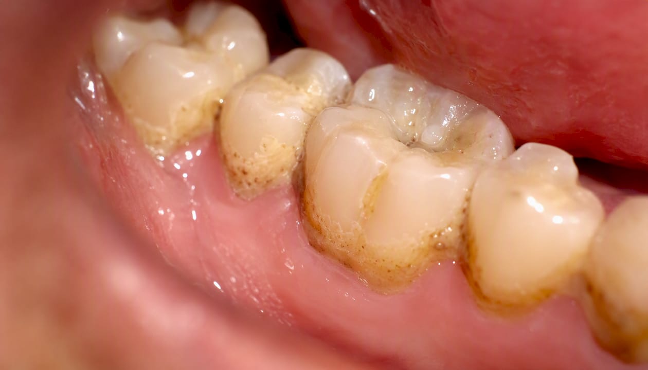 Close-up teeth showing plaque and tartar