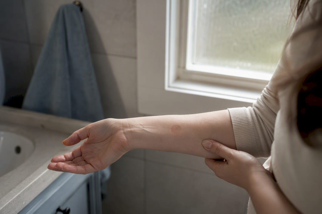 Patch test redness on inner forearm skin