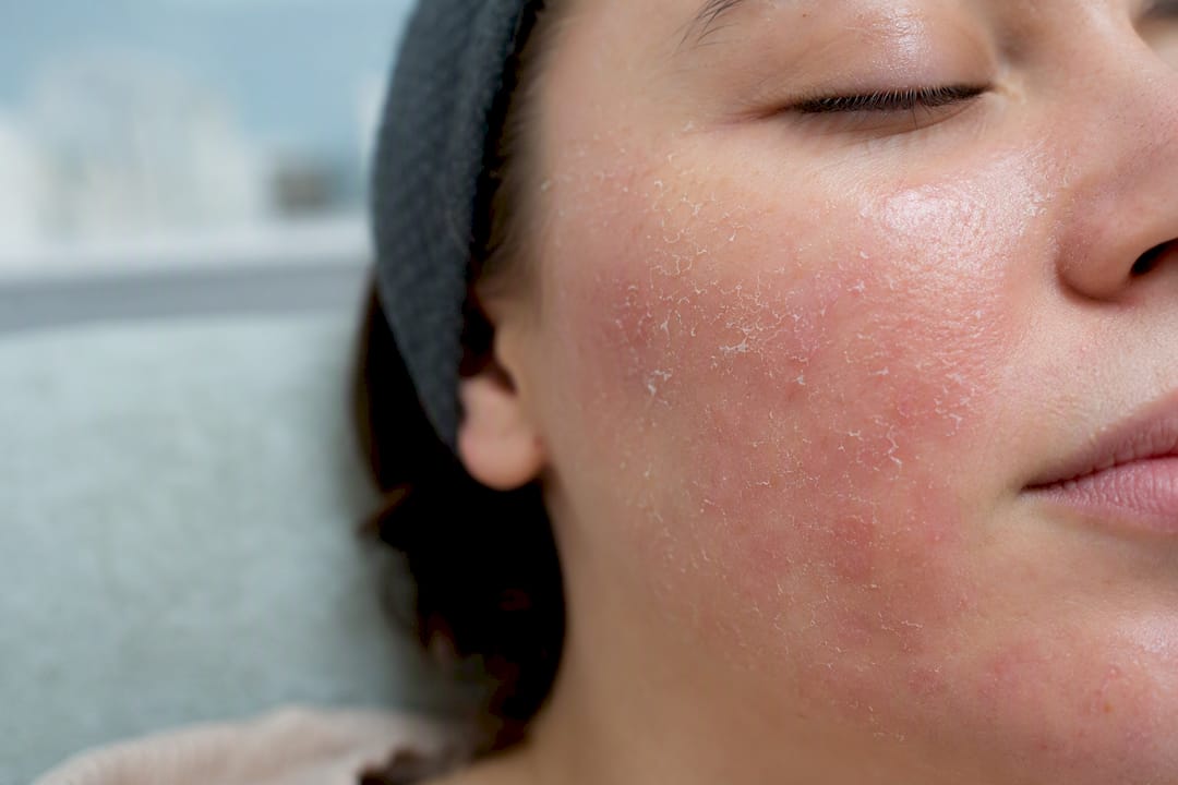 Close-up of facial skin after light chemical peel