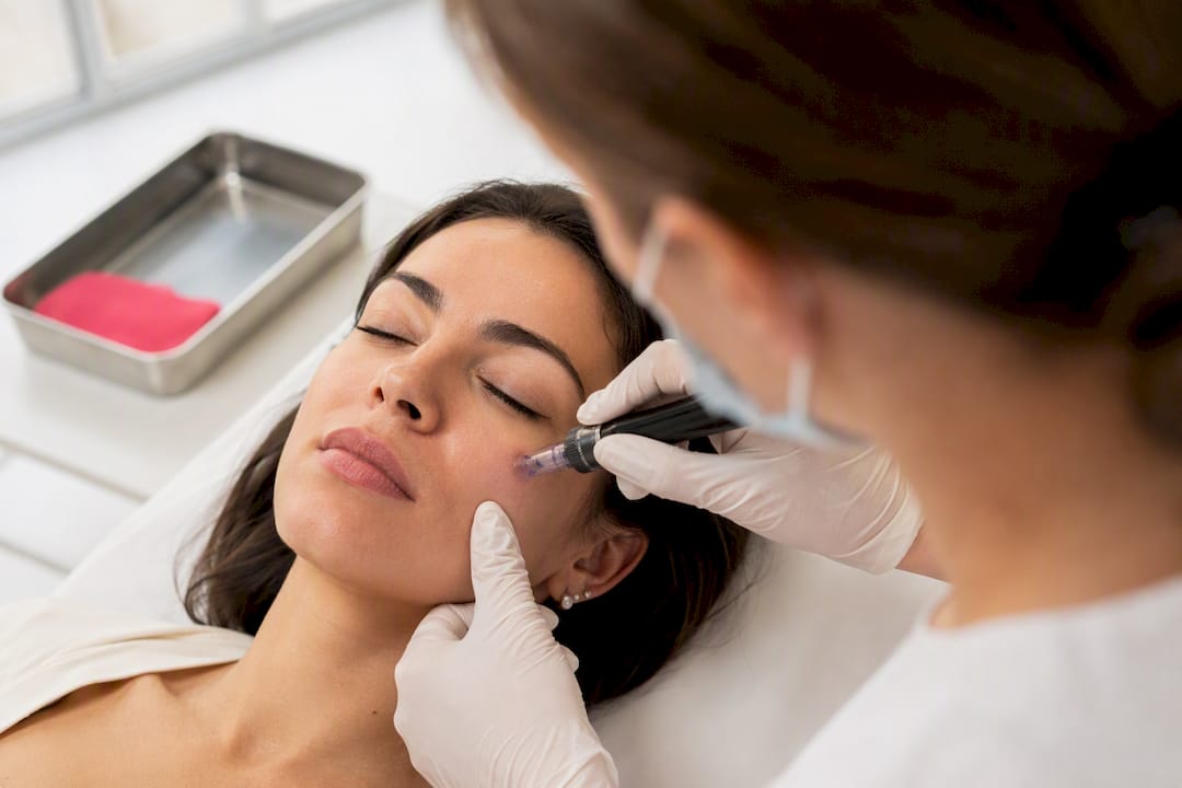 Επαγγελματικό microneedling στο μάγουλο