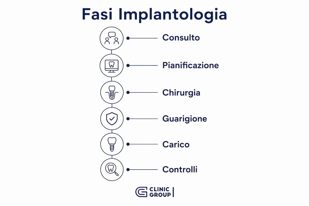 Scopri tutte le tappe dell’intervento di implantologia con una pratica infografica.
