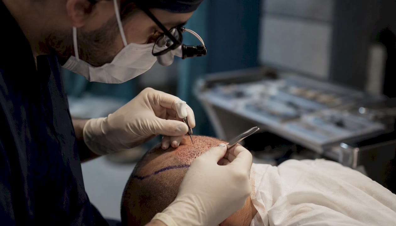 Le mani dell’operatore impegnate nell’estrazione dei follicoli durante la procedura HST
