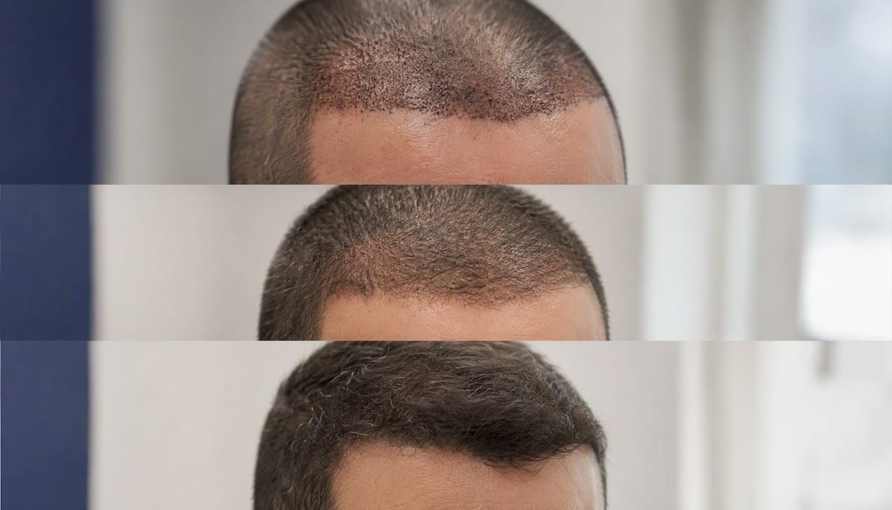 Evoluzione della ricrescita dei capelli sul cuoio capelluto dopo il trapianto