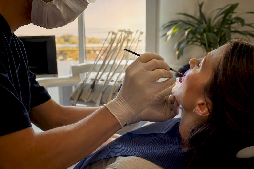 Il dentista stende uno strato di gel al fluoro sui denti per proteggerli e rinforzarli.
