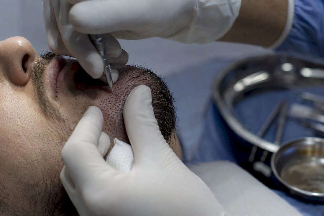 Primo piano del chirurgo mentre impianta i follicoli della barba