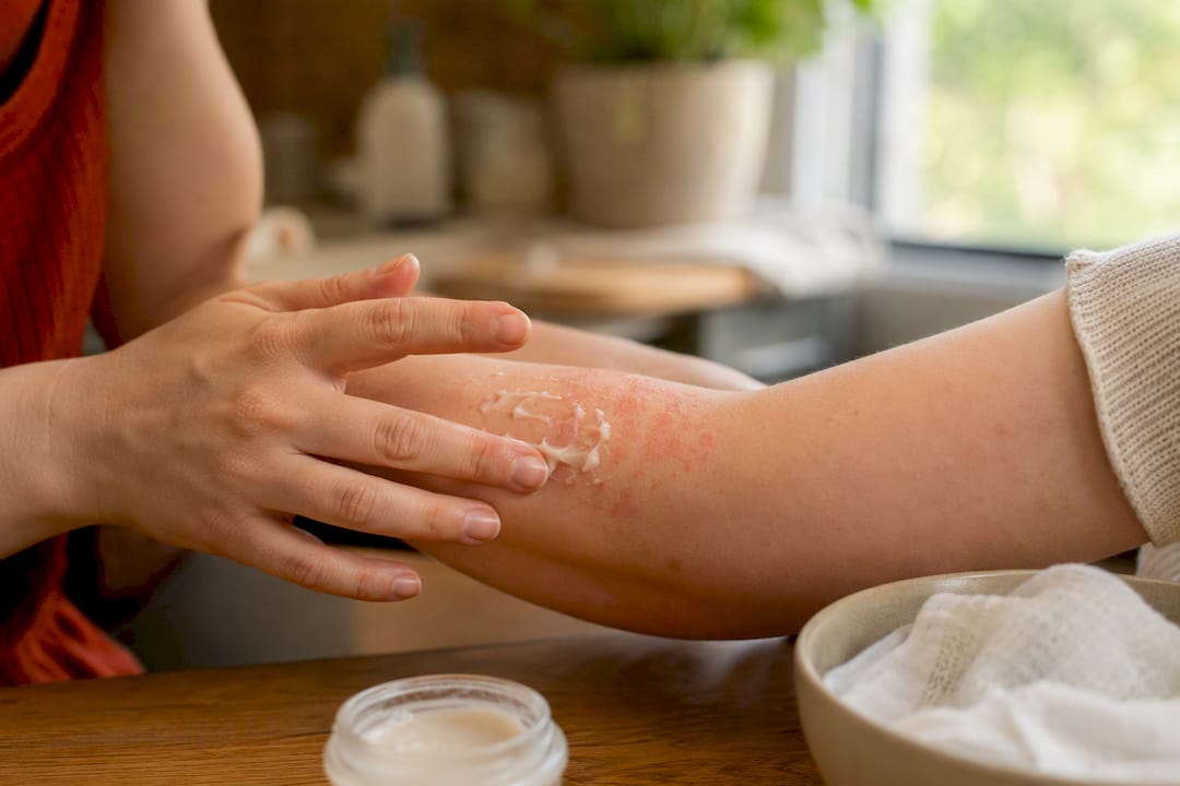 Applying ointment on adhesive allergy rash