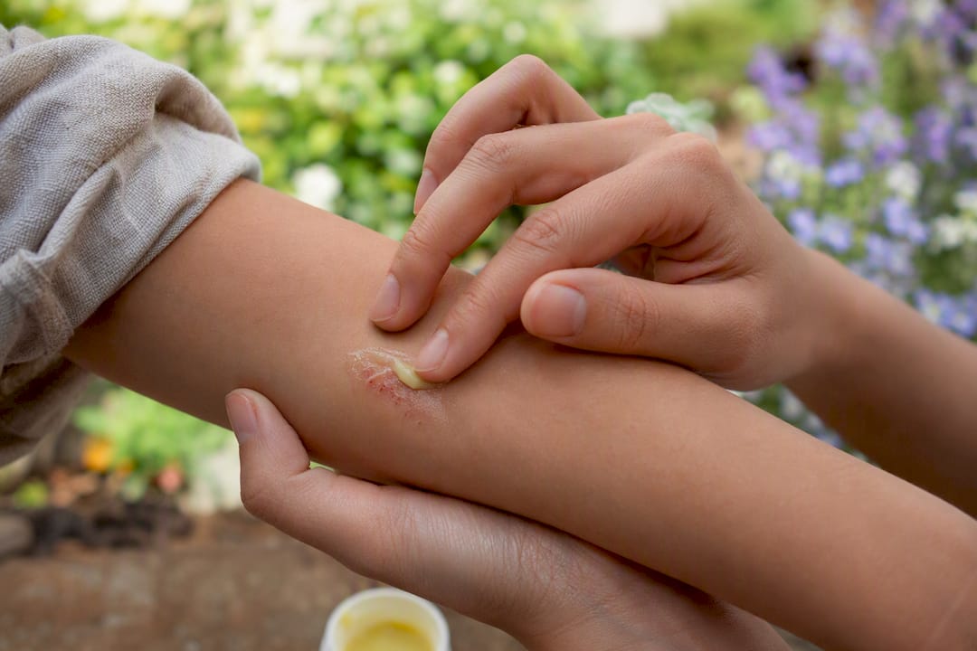Hands applying plant-based ointment on arm injury
