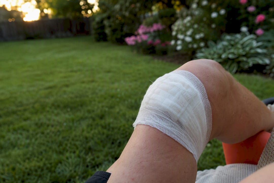 Bandaged large burn blister on elbow