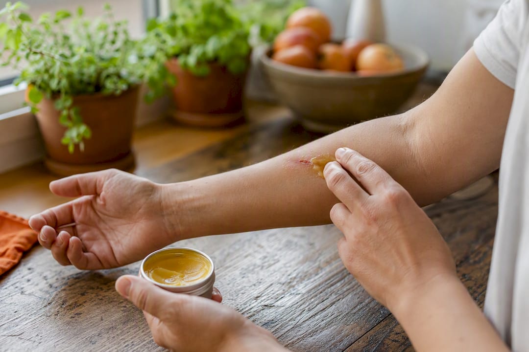 Hands applying calendula ointment on skin wound