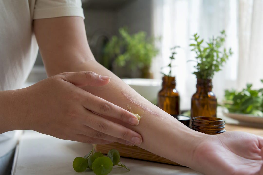 Applying gotu kola ointment to healing scar