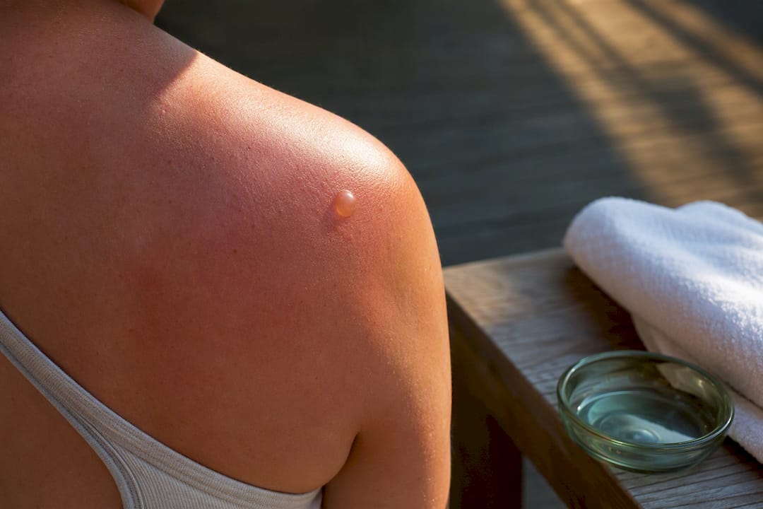 Intact blister on sunburned shoulder