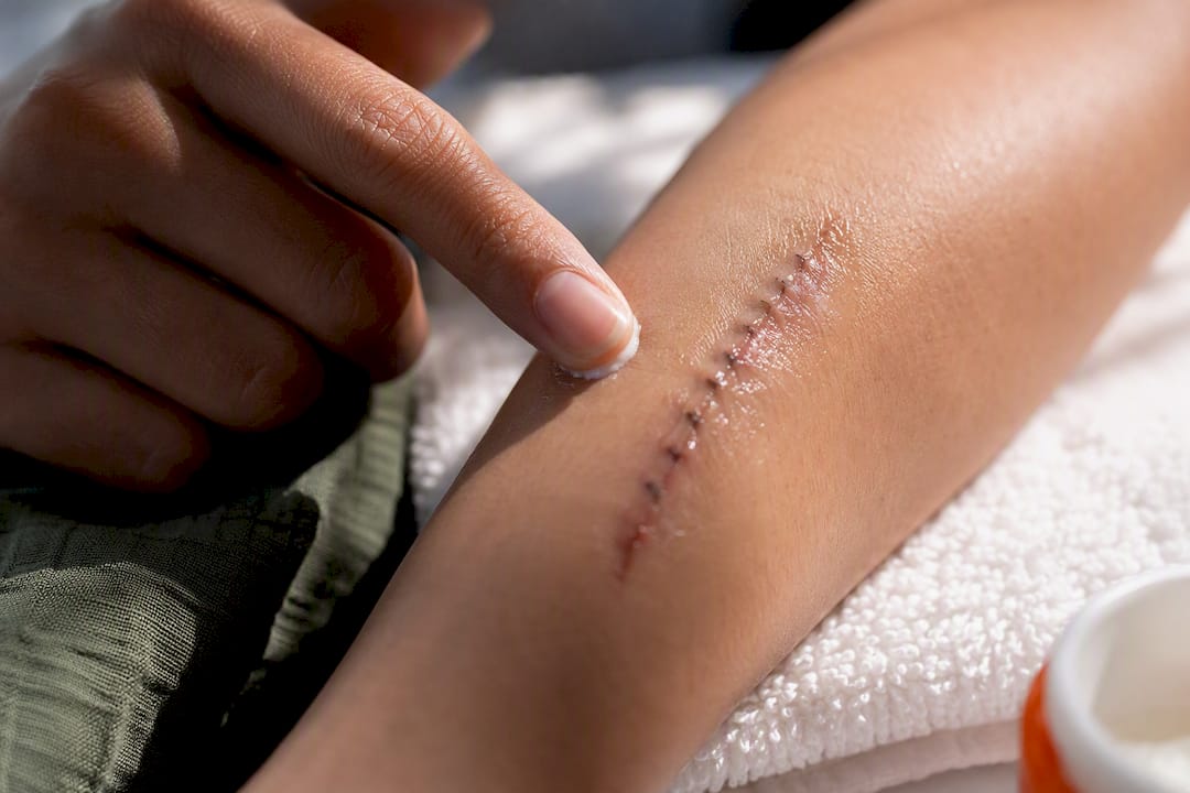 Thin ointment film over clean stitches