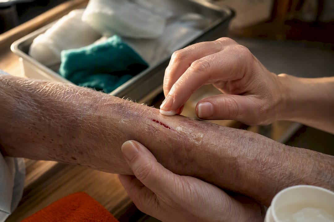Caregiver applying topical ointment near skin tear