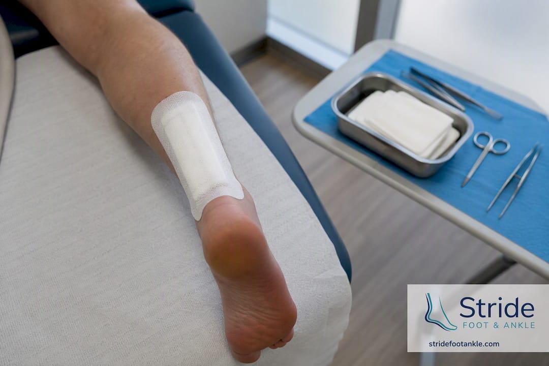 Sterile dressing on Achilles surgery wound