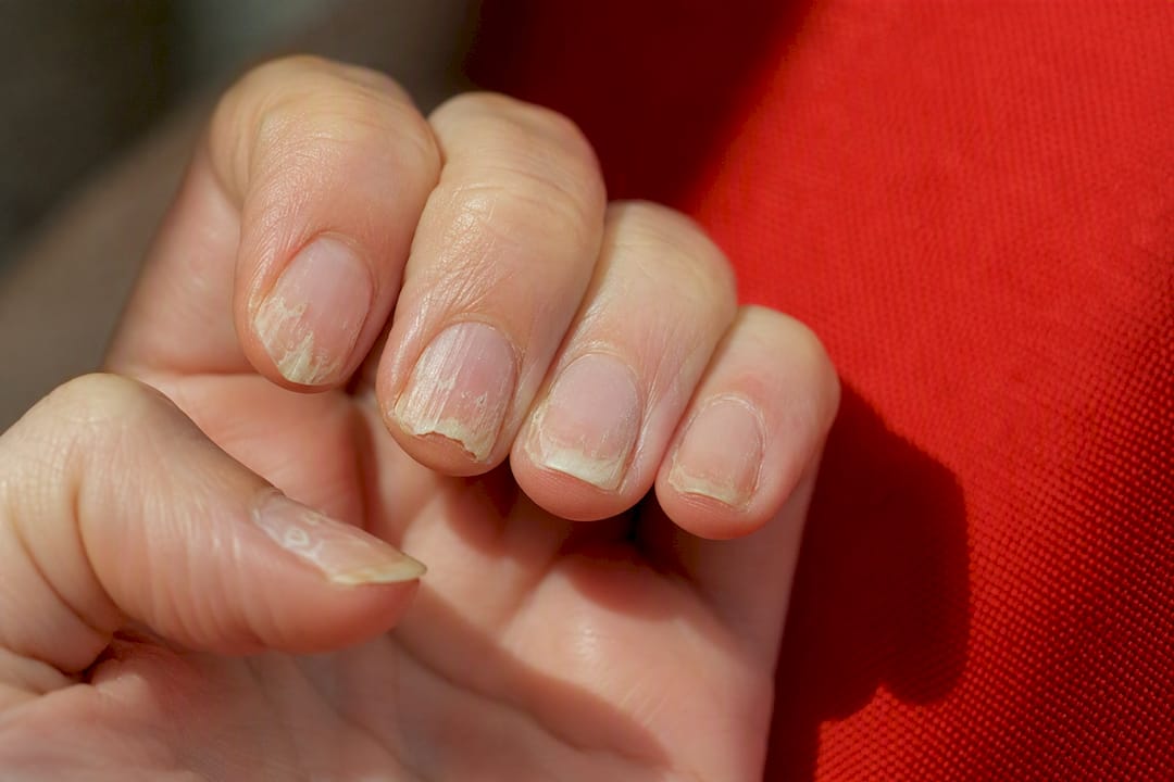 Brittle nails with medical issue signs