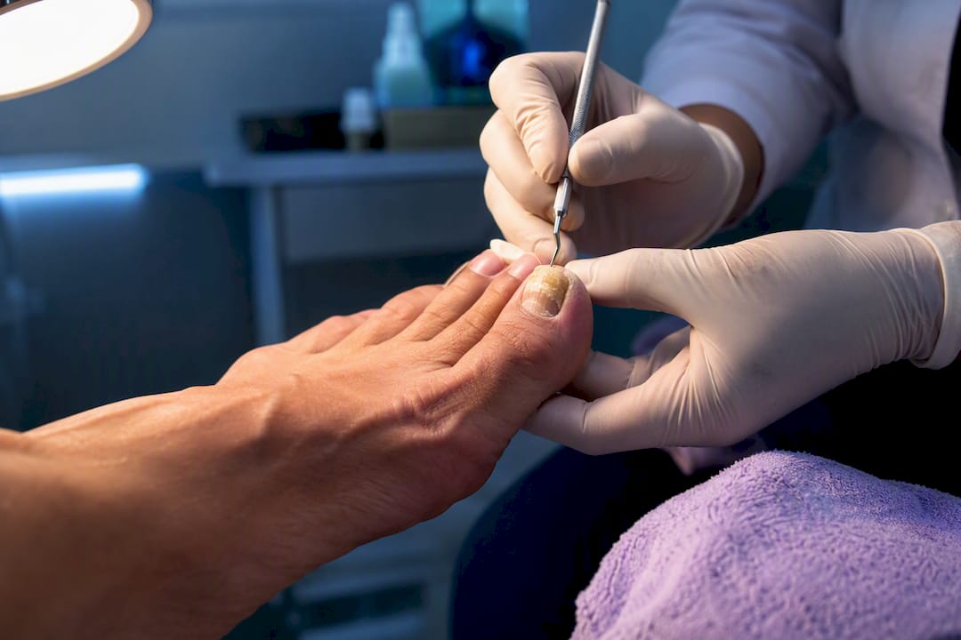 Clinician examining discolored toenail