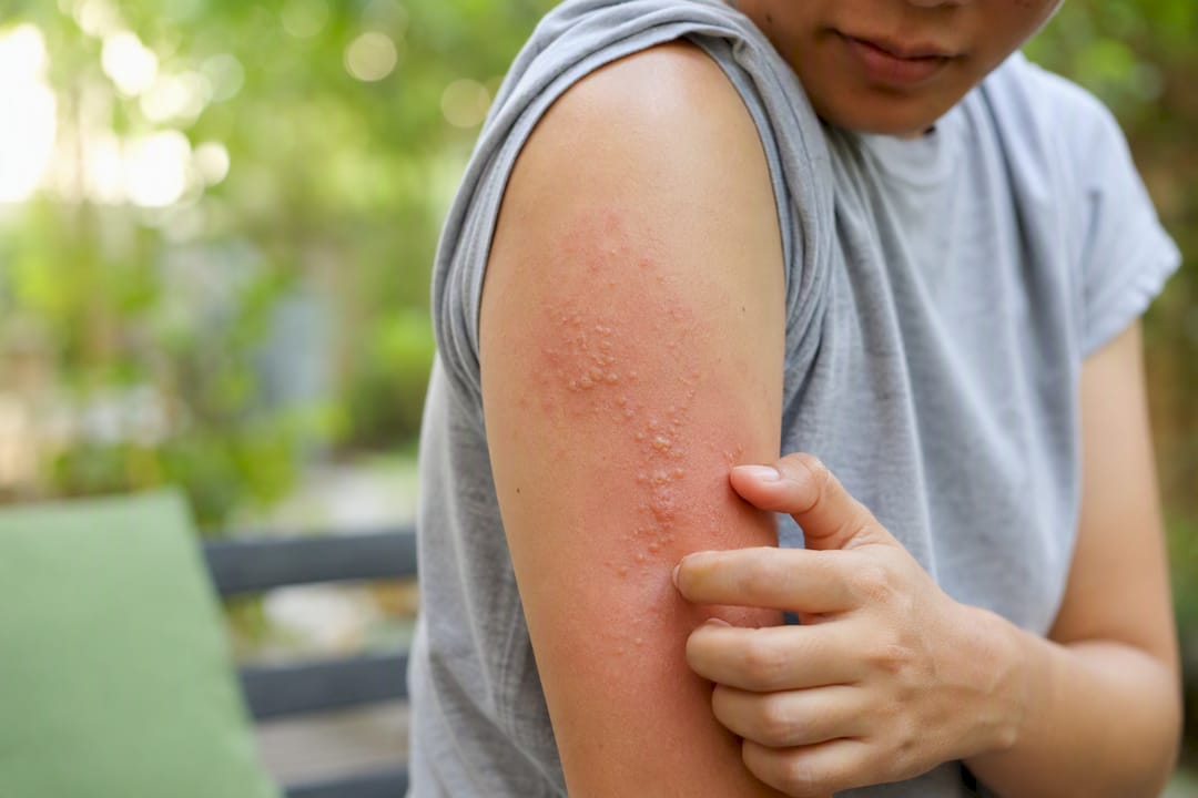 Inflamed allergic rash on upper arm