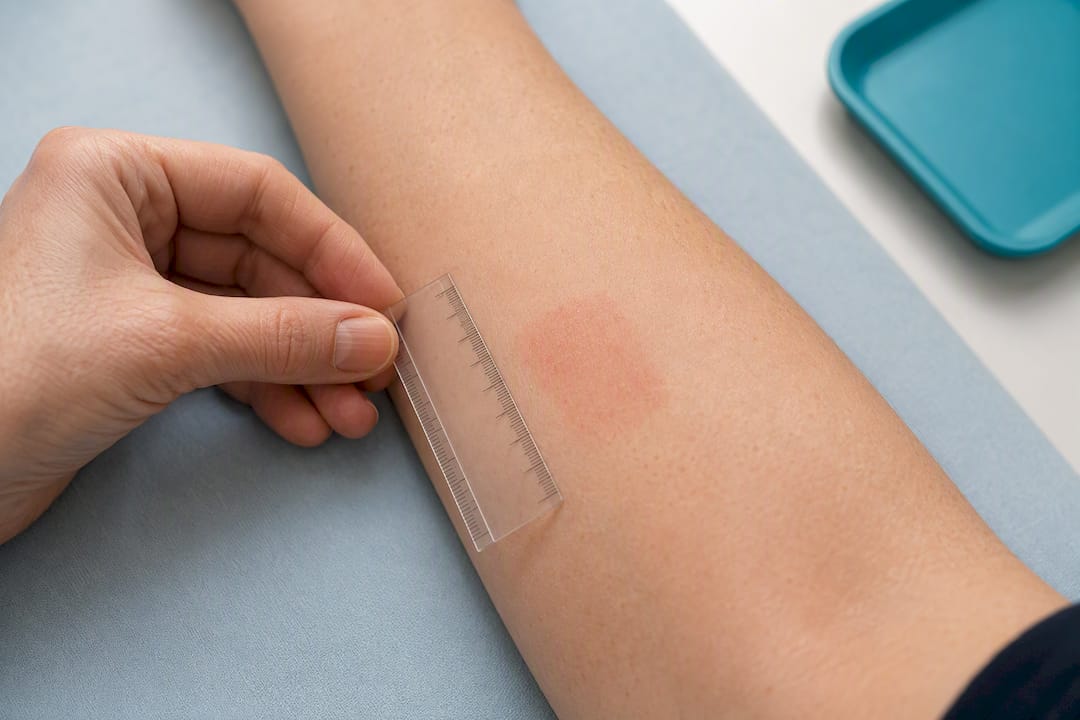 Ruler measuring a patch skin reaction