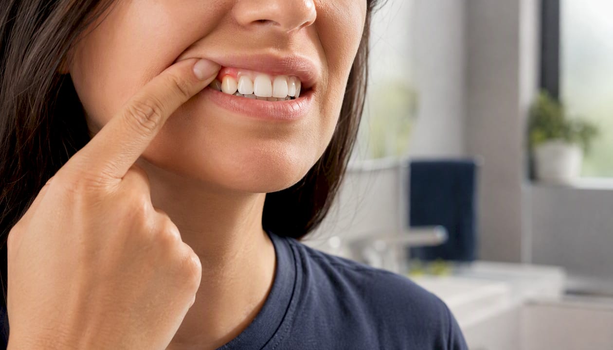 Close-up of mouth showing mild gum sensitivity
