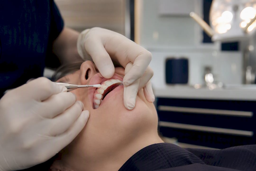 Dentist applying whitening treatment on teeth close-up