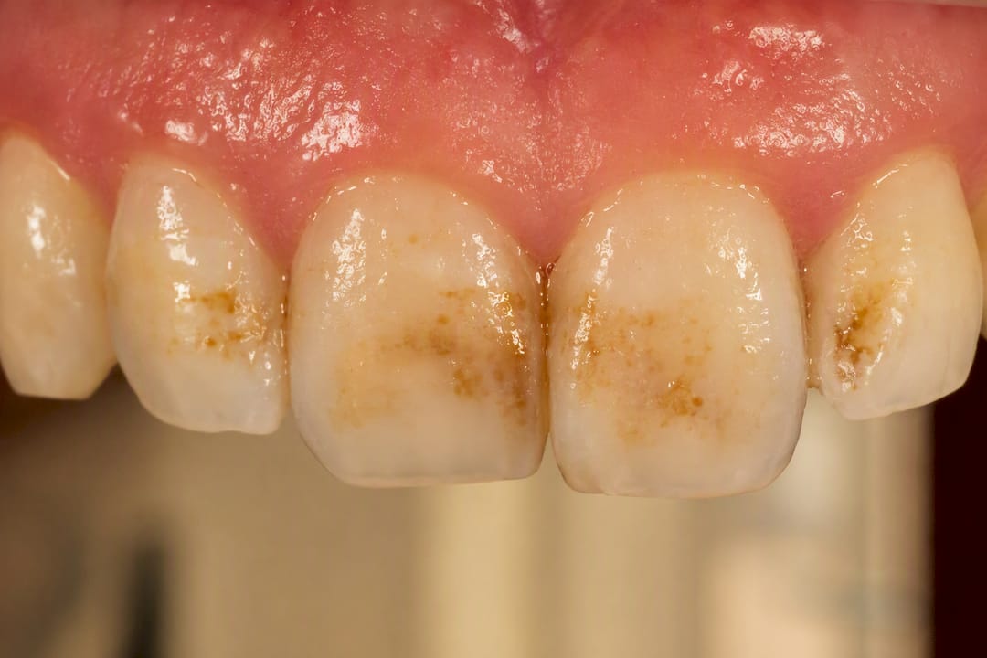 Close-up of stained tooth enamel