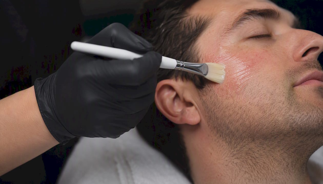 Clinician applying chemical peel on male cheek