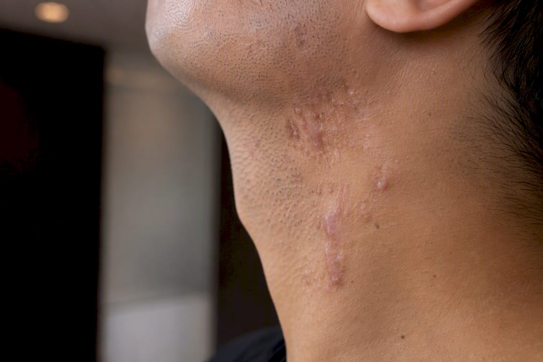 Close-up of male neck scars showing types