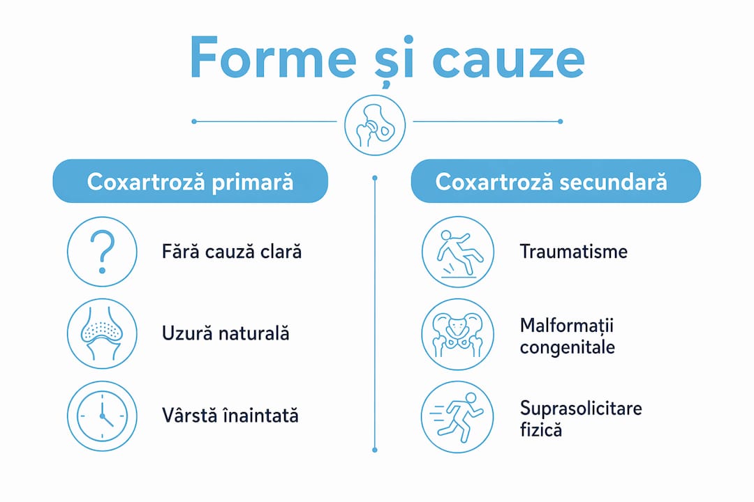 Infografic: diferențele dintre coxartroza primară și cea secundară