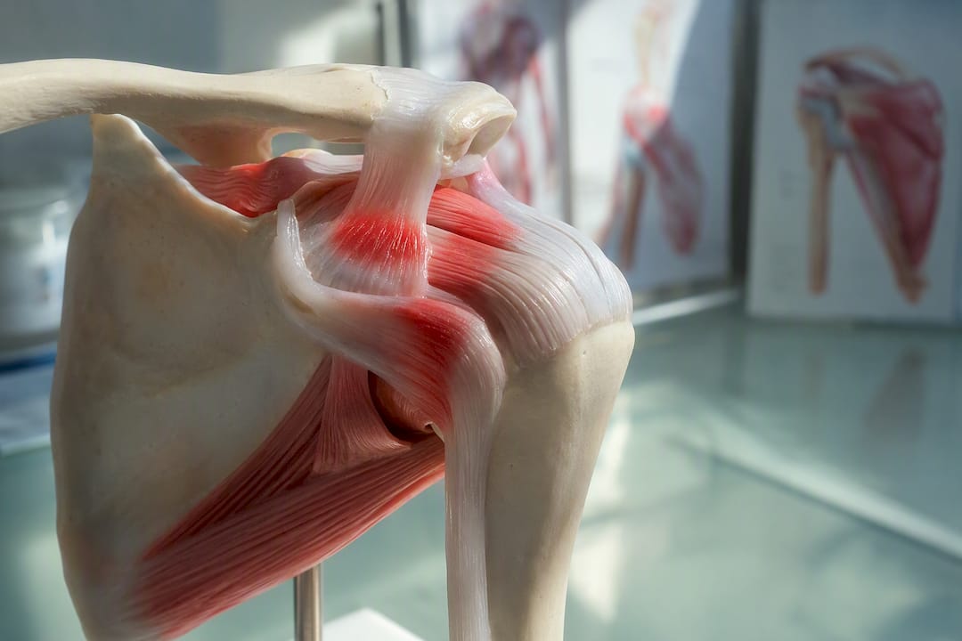 Model anatomic al umărului care evidențiază o zonă inflamată