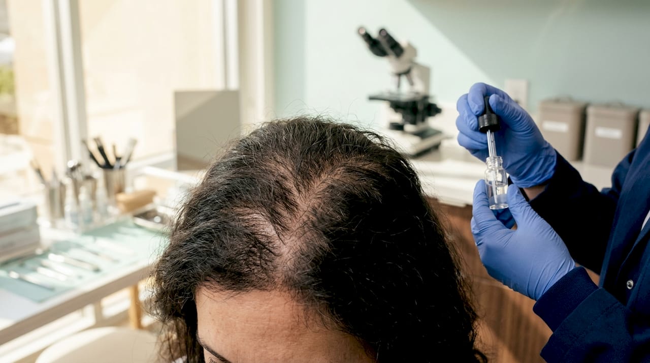 Close-up scalp showing DHT binding at hair follicle