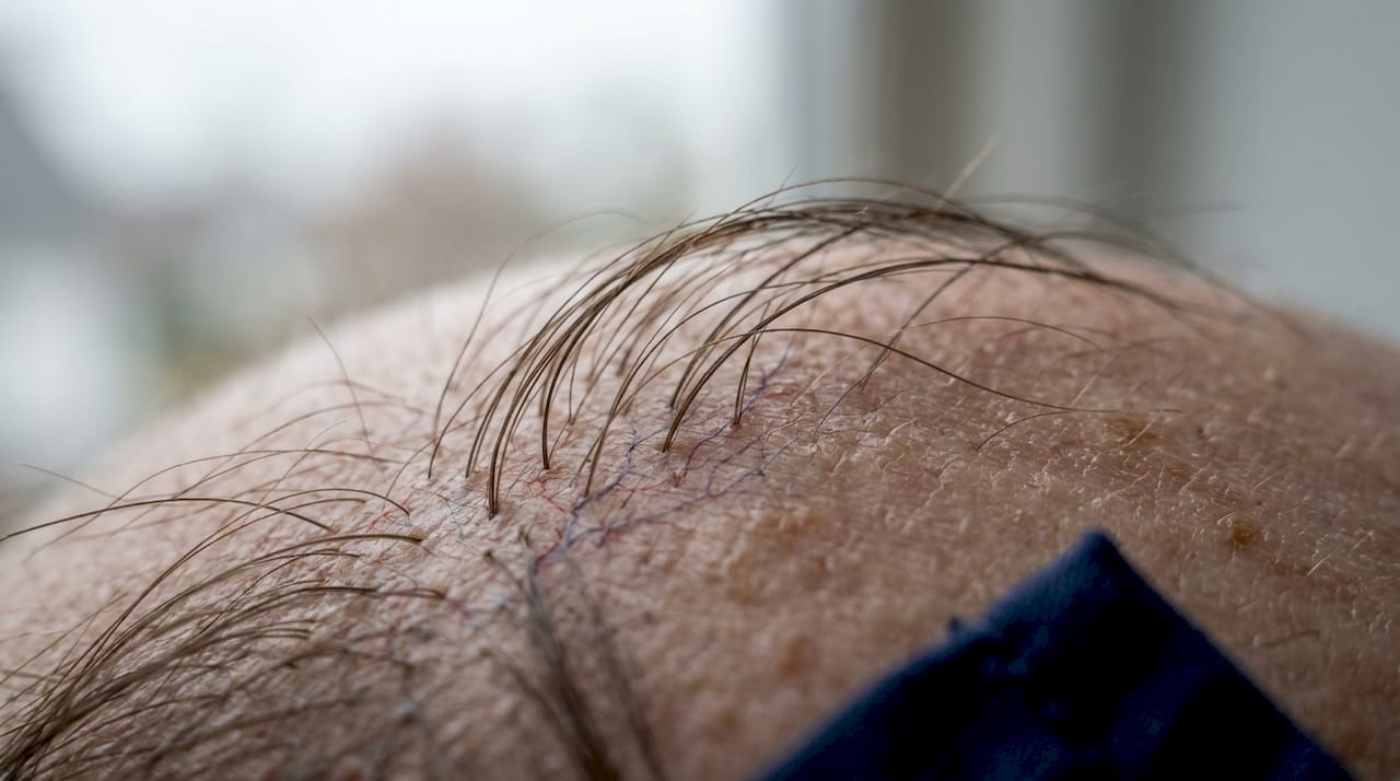 Close-up scalp hair follicle blood vessels