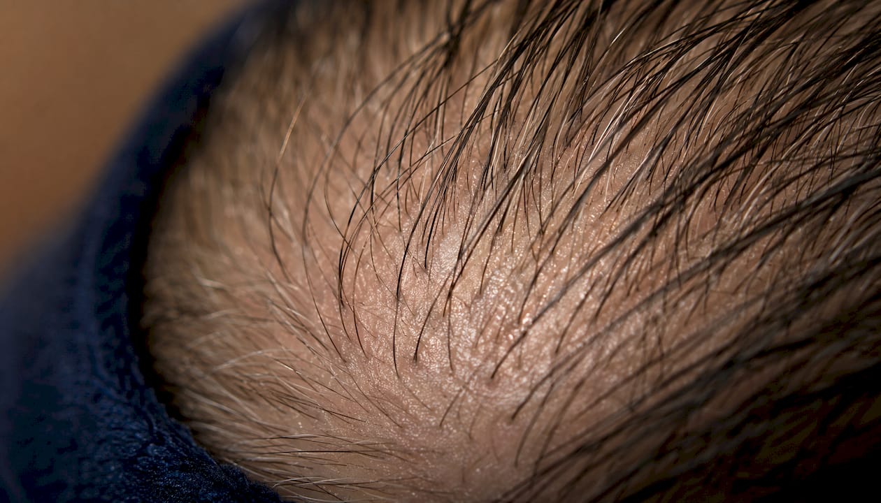Close-up of scalp showing hair follicles and sebaceous glands