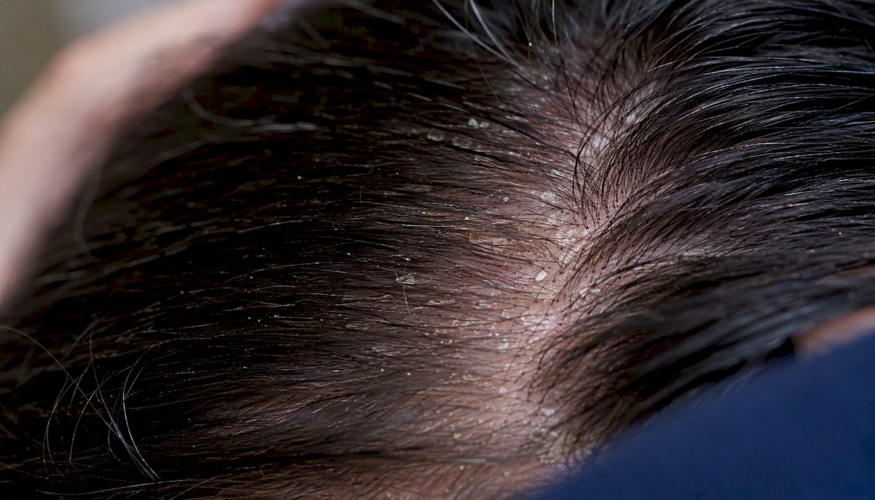 Close-up of dry scalp flakes on hair