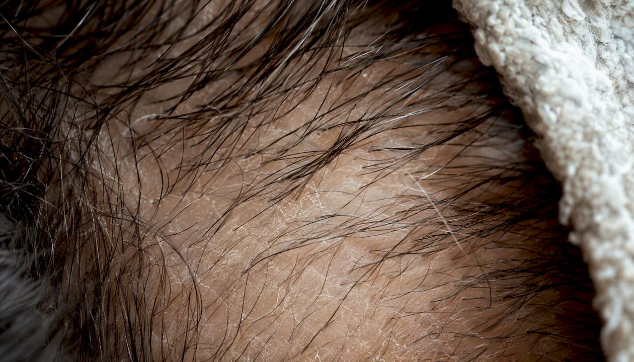 Close-up of scalp skin texture